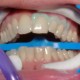 sbiancamento-dentale-2